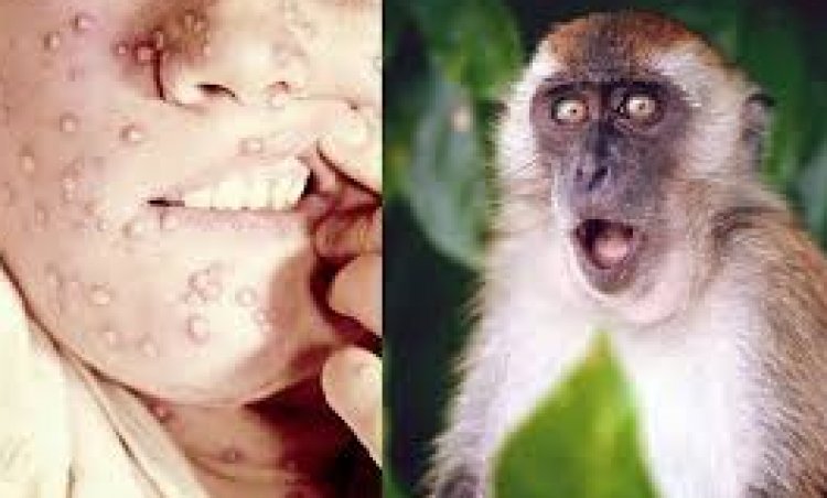 النواب يطالب الصحة بإعلان تفاصيل فيروس «جدري القرود»