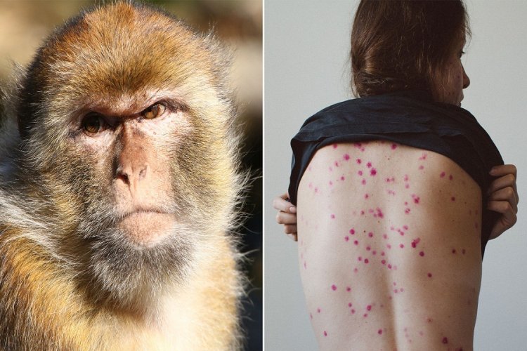 الصحة: لا يوجد علاج لمرض «جدري القرود» في مصر حتى الآن
