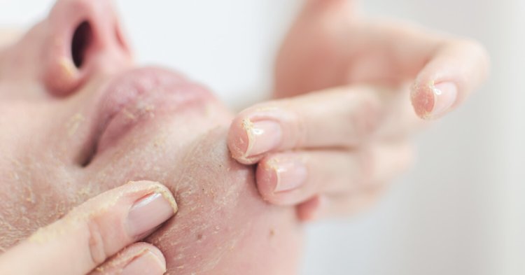 4 وصفات طبيعية لإزالة الجلد الميت